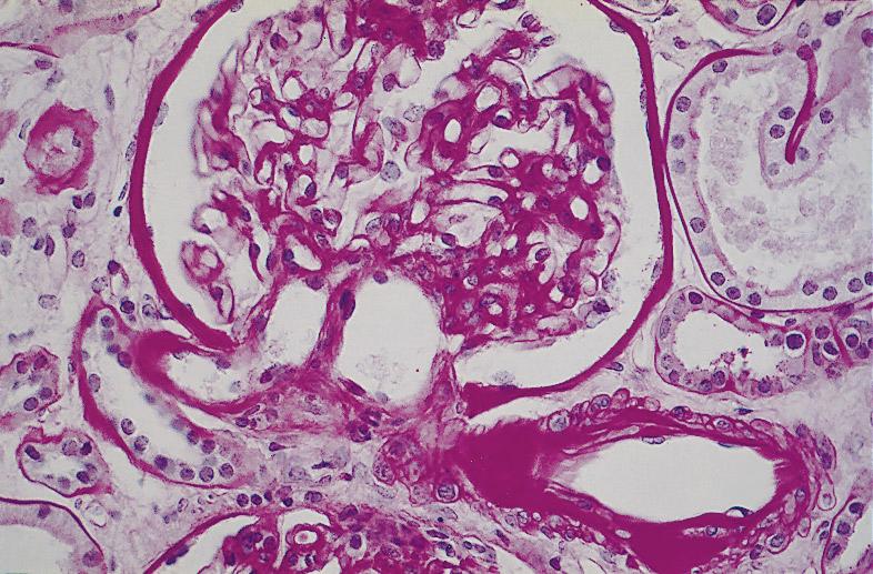 Glomerular structure is near normal in one glomerulus, while the adjacent shows global glomerular sclerosis (PAS) group of 19 age and sex-matched normal control subjects: 85 135) and AER was 44 (20