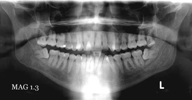 There is also a wide radiopaque band from the cervical spine projected over the anterior jaws: this results from a slumped position.