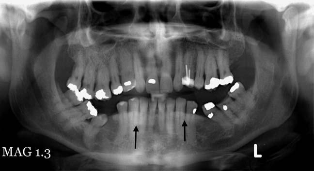 In this patient with mixed dentition, the head is rotated to the left resulting in subtle apparent widening of the left mandibular ramus and of the left molar teeth. Fig. 2. Chin-down artefact.