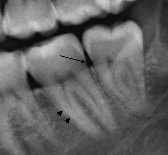Arrows denote mesial (M), distal (D), buccal (B) and lingual (L) directions. Fig. 8. Radiographic dental anatomy on a cropped orthopantomogram.