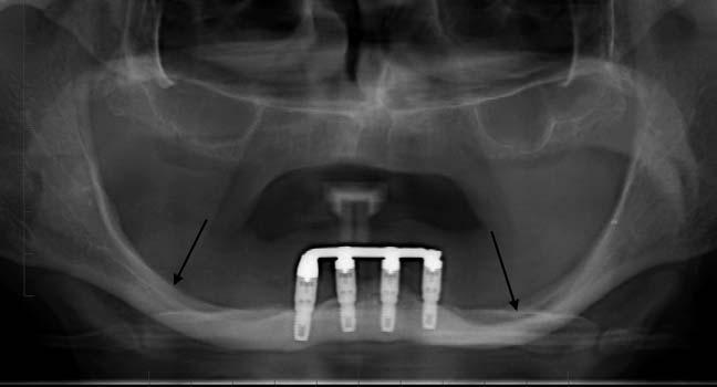 DENTAL PANORAMIC TOMOGRAPHY 529 Fig. 10. Cropped orthopantomogram in a chronically edentulous patient. Note the marked resorption of alveolar bone from both the maxilla and the mandible.
