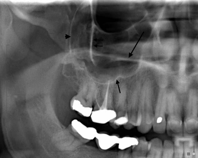 standing dentition is counted and retained root fragments, supernumerary teeth and unerupted teeth are noted and described.