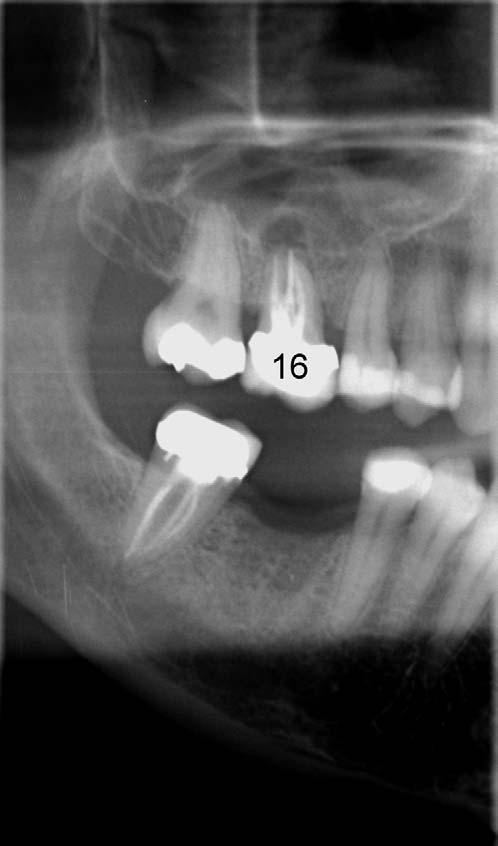Partial anodontia: the mandibular second premolar teeth are absent and the corresponding deciduous molar teeth (known as 75 and 85 in the Fédération Dentaire Internationale system) are still standing.