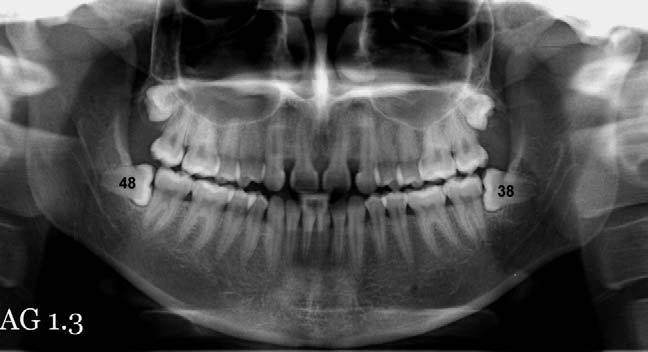 530 R BOEDDINGHAUS AND A WHYTE Fig. 14. Partial anodontia: the maxillary lateral incisors (12 and 22) are absent. Note also horizontal impaction of the mandibular third molars (38 and 48).