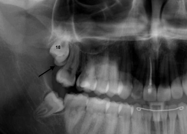 Anodontia implies developmental absence of teeth: complete anodontia is rare, but partial anodontia is not uncommon, especially of third molars, mandibular second premolars (Fig.