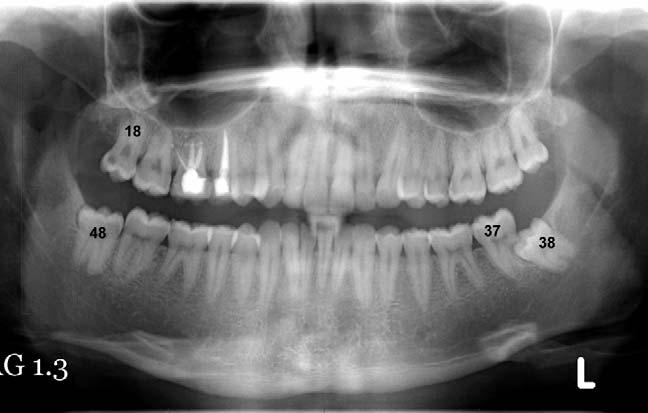 15) followed by supernumerary molar teeth, usually situated distal to the third molar (Fig. 16)