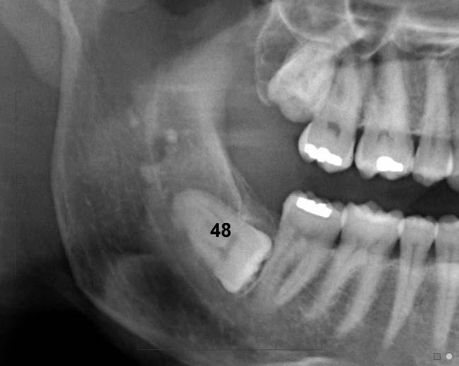The calcifications projected over the mandibular ramus have the characteristic appearance of postinflammatory calcifications in the faucial tonsils, a common incidental finding. Fig. 22.