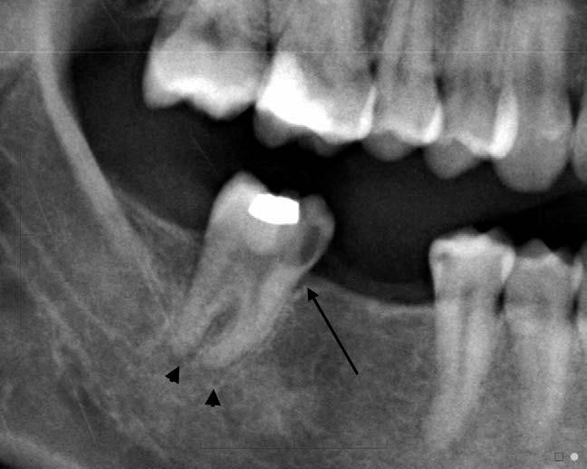 Recurrent distal dentinal caries are present in the heavily restored 26 and 36 teeth. A post crown is present in 35. Fig. 20.