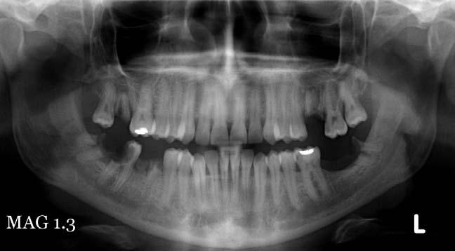 Note the characteristic ballooning of the carious lesion once it reaches the dentine, which is less resistant to decay than enamel.
