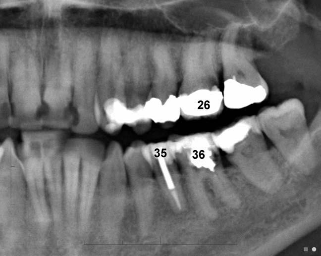 Periodontitis is a common destructive process, secondary to chronic gingivitis, manifest radiographically by loss of alveolar bone.