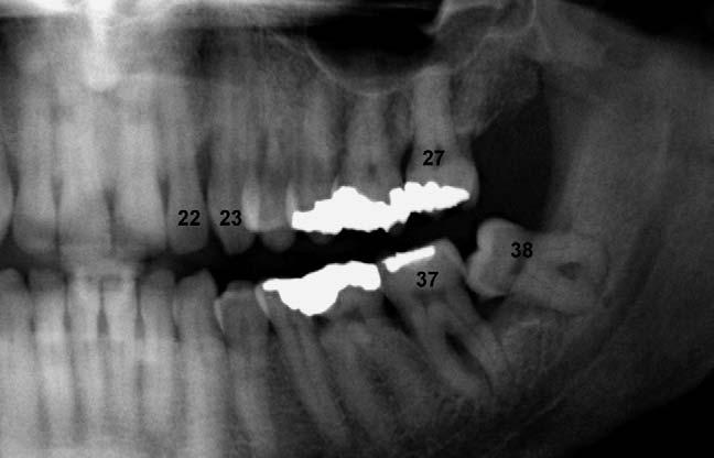 532 R BOEDDINGHAUS AND A WHYTE Fig. 26. Small periapical abscess related to the heavily restored lower right second molar tooth (47). defined.