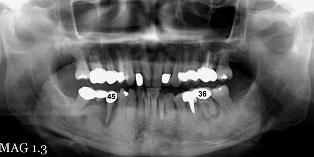 There is mild horizontal alveolar bone loss, with blunting of the alveolar crest between the anterior teeth, and rounding of the junction between the crest and the lamina dura.