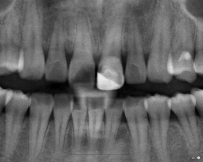 6 These may be multiple in Gardner s syndrome. Hypercementosis is excessive deposition of cementum on the tooth roots, usually idiopathic.
