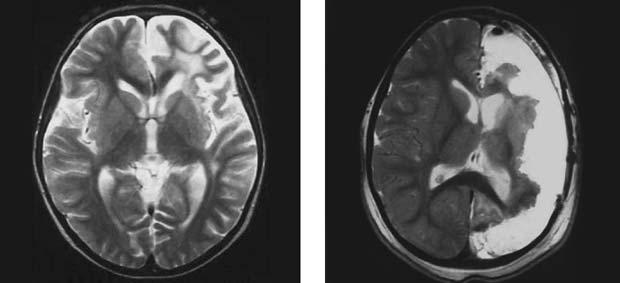 A Figure 3 Epilepsy surgery in Rasmussen s encephalitis. (A) Rasmussen s encephalitis involving the right hemisphere. Note brain atrophy and signal changes involving the entire right hemisphere.