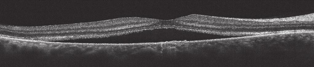 associated with overlapping superﬁcial retinal vessels.