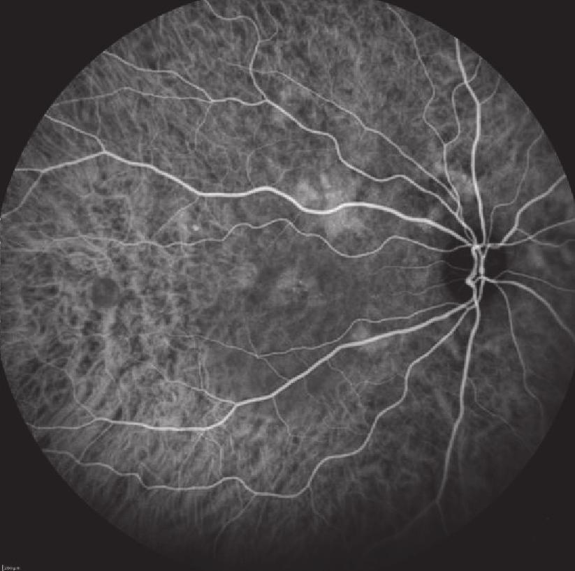 RPE disorders (arrows). (d) OCT B-scan two regular, dome-shaped PEDs in the center of the macula with small amount of subretinal ﬂuid.