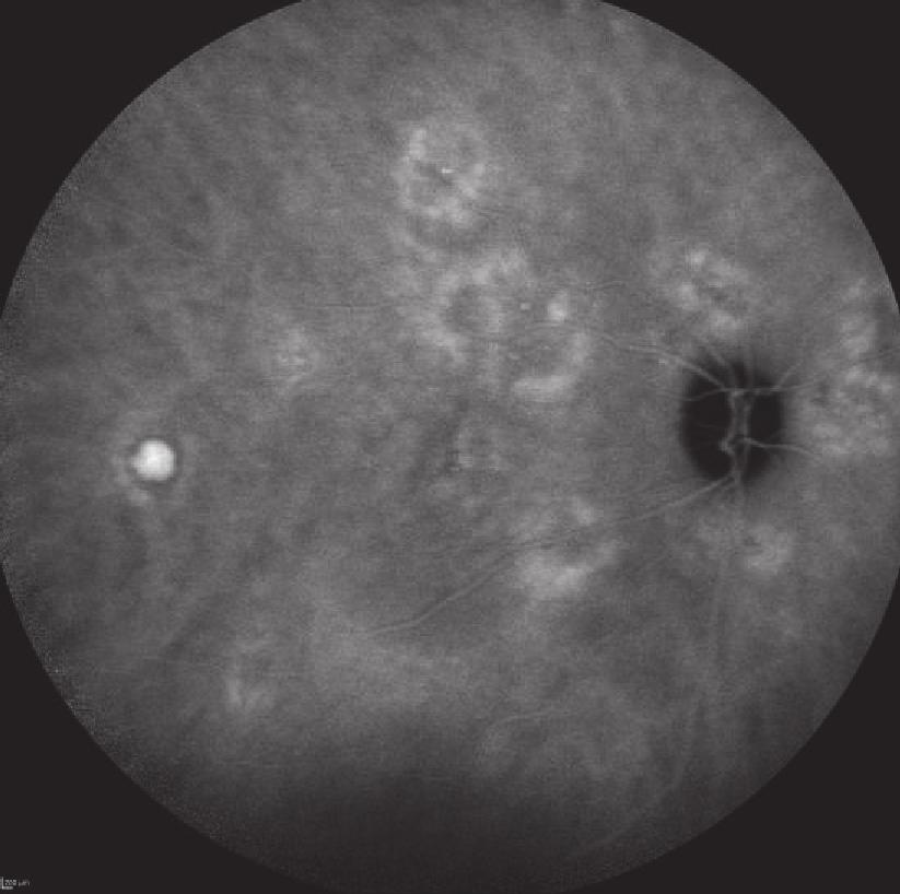 It is important to realize that abnormal choroidal vascular pattern is not always associated with CNV.