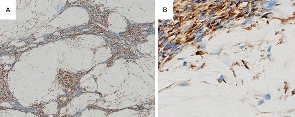 Figure 4. Immunohistochemical findings. A. Spindle cells were diffusely positive for a pan-cytokeratin marker (AE1/ AE3) ( 40). B.