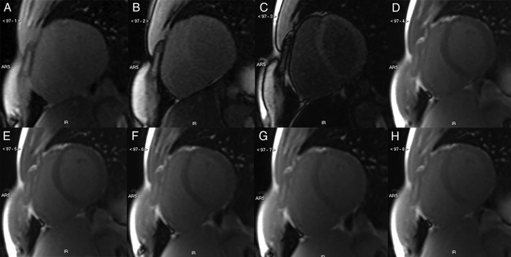 E66 P.M. Cannaò et al. Figure 2 T1-weighted short-axis images of a healthy subject using a MOLLI sequence as in Figure 1, 15 min after intravenous injection of 0.