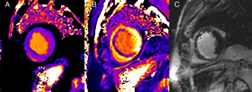 E68 P.M. Cannaò et al. Figure 4 A 56-year-old male with left ventricle hypertrophy (amyloidosis). In (A), a short-axis, end-diastolic image showing a marked hypertrophy of the lateral wall.