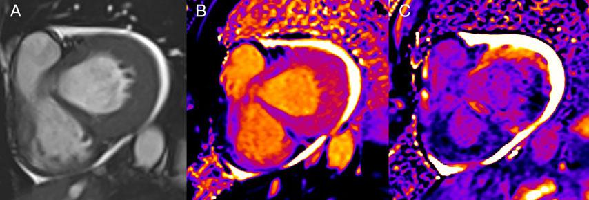 1 mmol/kg of Gadobutrol shows reduced signal intensity, as expected in the case of amyloid infiltration. Figure 5 A 61-year-old male with chronic myocardial infarction.