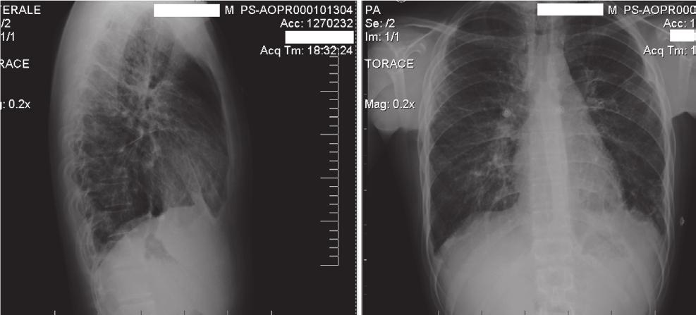 Pulmonary Hypertension, Unusual Presentation 69 Figure 1. Posteroanterior and lateral chest-x-ray: bilateral interstitial opacities, dilatation of the azygos vein and mild cardiac enlargement.