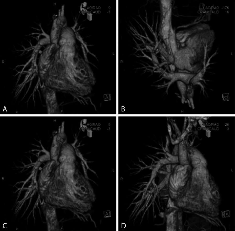 Pulmonary Hypertension, Unusual Presentation 71 Figure 4. High-contrast 3D visualization of heart and pulmonary vessel tree with syngo InSpace 3D.