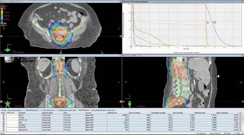 Multiple spine metastases stereotactic treatment plan showing a homogeneous dose distribution for the S1 lesion while achieving a conformality index
