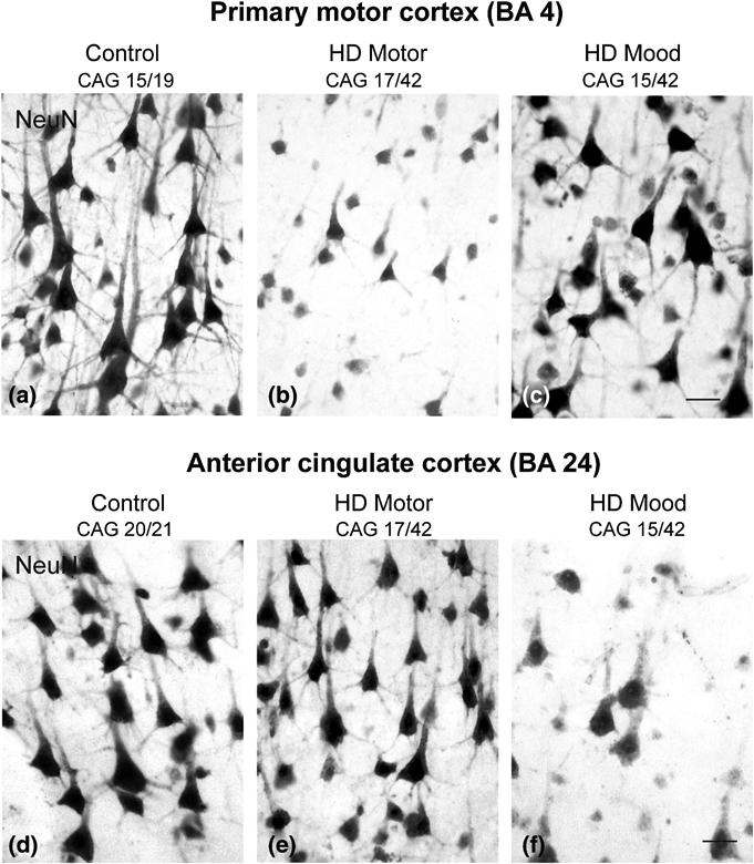 H.J. Waldvogel et al. Fig. 7 Cell loss in the primary motor cortex and cingulate cortex in Huntington s disease.