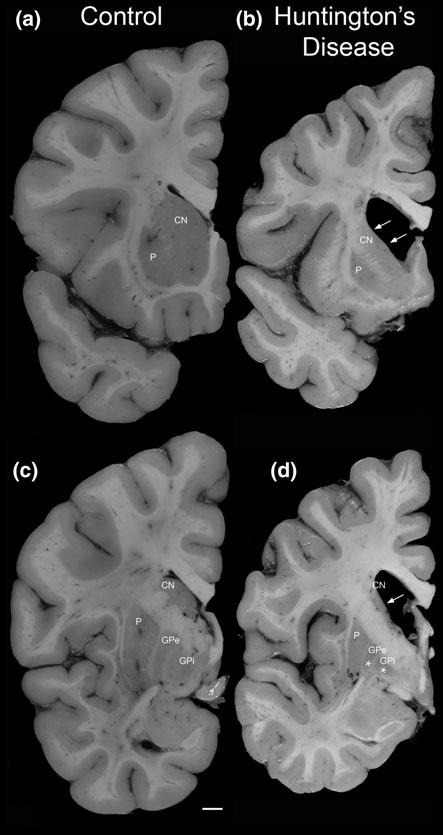 H.J. Waldvogel et al. Fig. 2 Pathology of Huntington s diseased brain.
