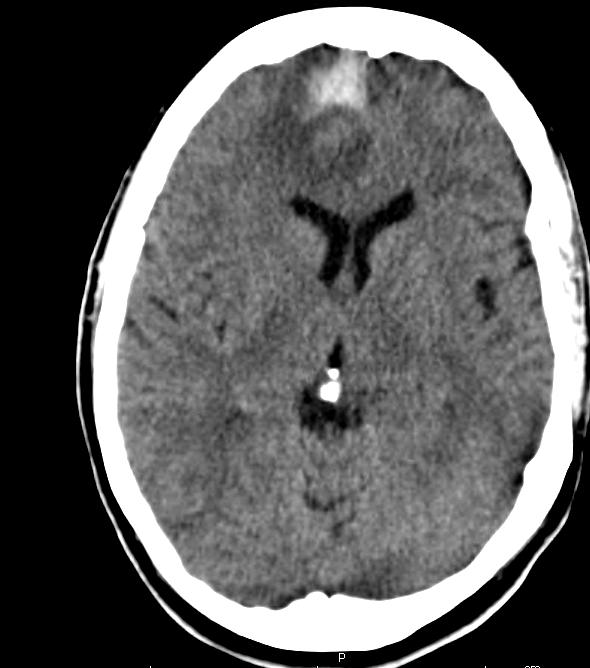2 Figure A. Admission CT head without contrast showing right frontal hemorrhage.