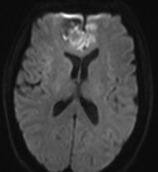 T1 with contrast (D) showing right frontal