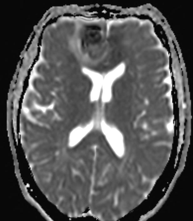 adjacent left frontal lobe, spares corpus