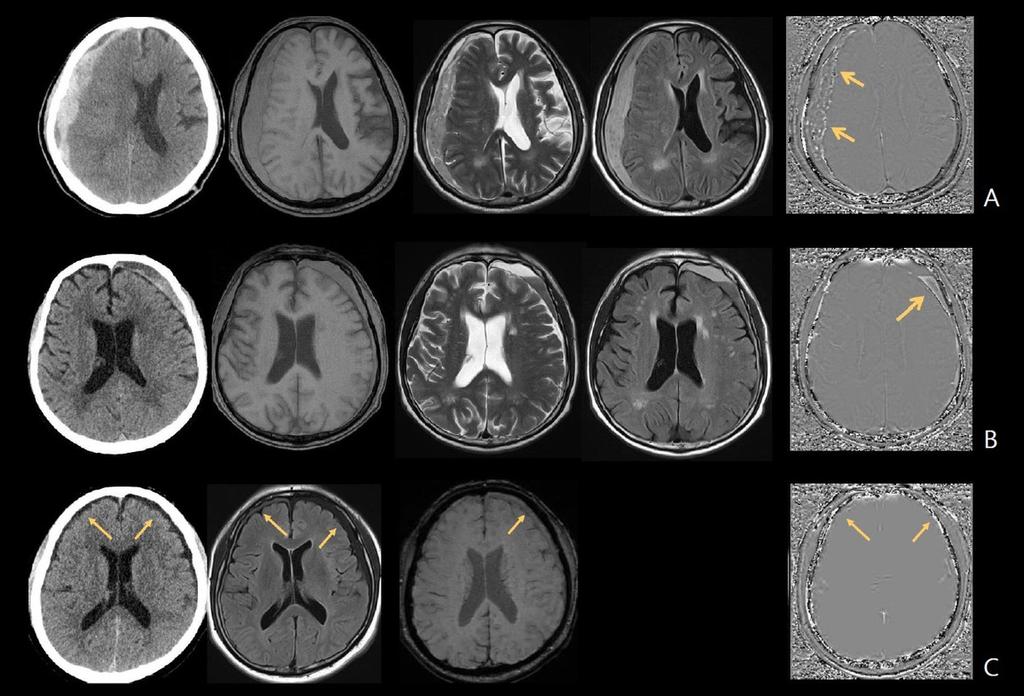 Fig. 2: Subdural hemorrhage(sdh) on CT and MRI with different values on phase image on 3 different stages. A, CT and MRI show acute SDH along the right cerebral convexity.