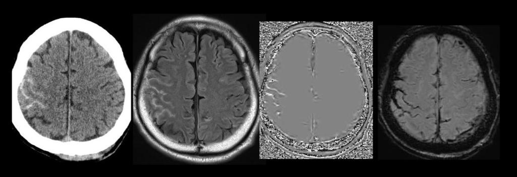 Phase image shows heterogeneous mixed bright and dark value(arrow). C, CT and MRI show late subacute to chronic stage of SDH along the both cerebral convexity(arrows).