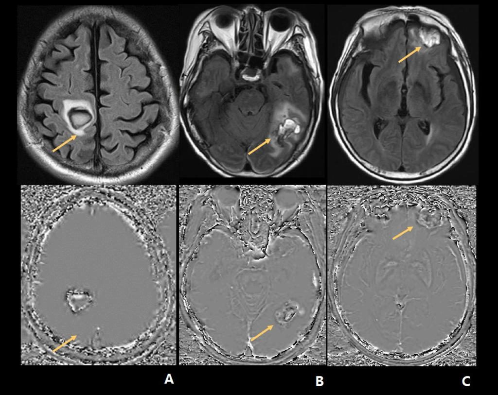 Fig. 5: Other cases more than 5-mm parenchymal hemorrhage on 3 different patients also show aliasing pattern on phase image.