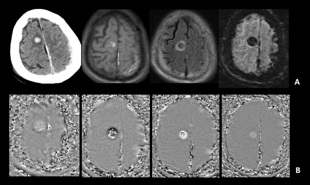 Fig. 6: Sixty-eight year old male patient with multifocal hemorrhagic brain contusion involving both cerebral hemispheres.