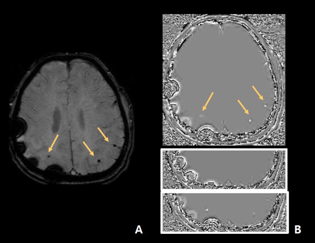 Fig. 8: Eighty-one year old female with microbleed less than 3-mm without dipole artifact in both cerebral hemisphere. A, SWI shows three dark signal in both parietal lobe.