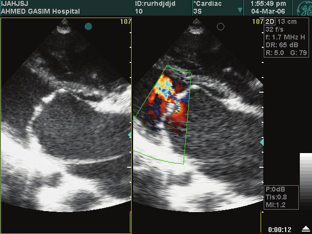prolapse of the anterior; on the right, colour flow Doppler showing the eccentric regurgitant jet between the 2 leaflets.