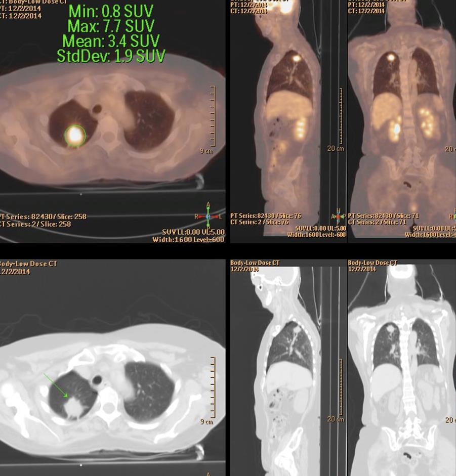 Case 1: images at diagnosis MRI PET-CT ct1bnm1 (IVb, solitary brain metastasis) Radical treatment indicated (January