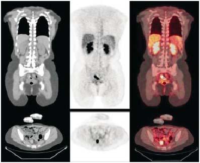 45 yo woman, stage III colorectal Ca resected; returns with rising CEA CT interpreted as