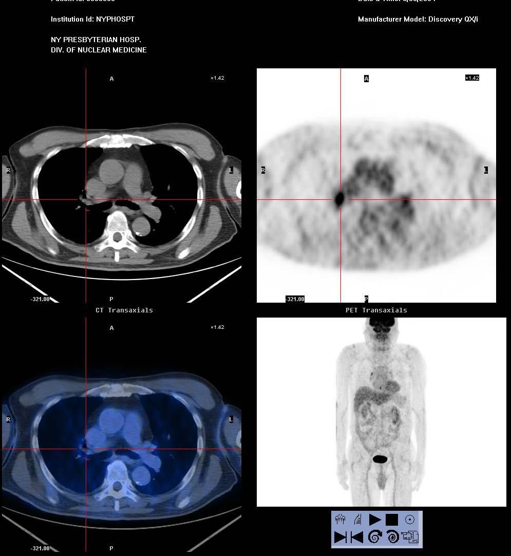 74 yo M Pulmonary nodule on CT; [FDG-]; granuloma on bx