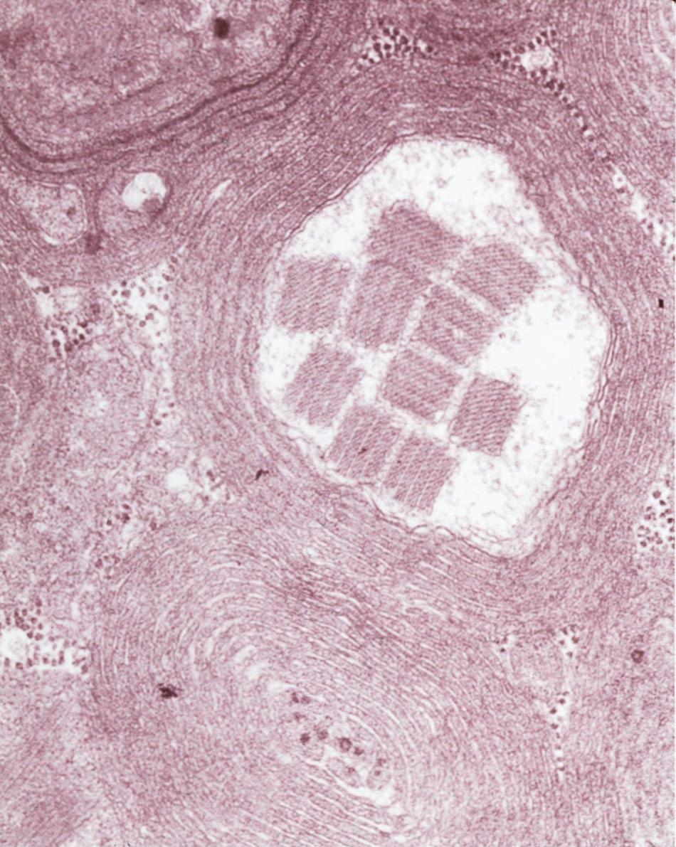 Figure 3. Muscle biopsy specimen as seen with electron microscopy revealing paracrystalline inclusions within the mitochondria (original 50,000). Photo courtesy of Dr. Steven Ringel.