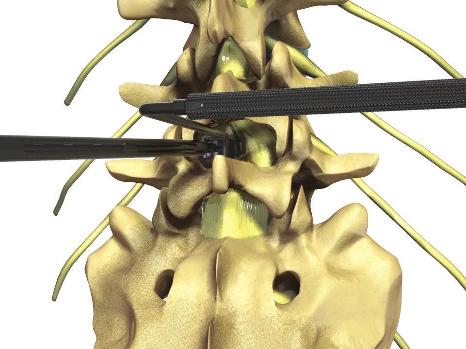 TM Ardis Interbody System Surgical Technique Guide 19 STEP 11 Implant Insertion Insert the implant into the disc space. Nerve root retractors are available for protection of the neural elements.