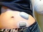 Insulin pump therapy Delivers insulin
