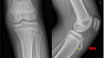 Figure 1 Plain radiograph of the left knee: Anteroposterior and Lateral view Lateral view: Soft tissue swelling (red arrow) and broadening of the growth plate of the apophysis of the tibial
