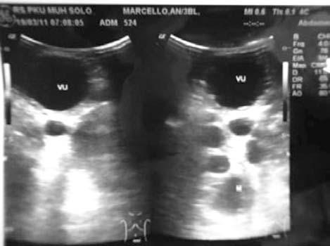 The abdominal USG showed bilateral hydronephrosis with a differential diagnosis of bilateral polycystic renal disease and suggested the presence of a mass behind the urinary bladder (Figure 1).