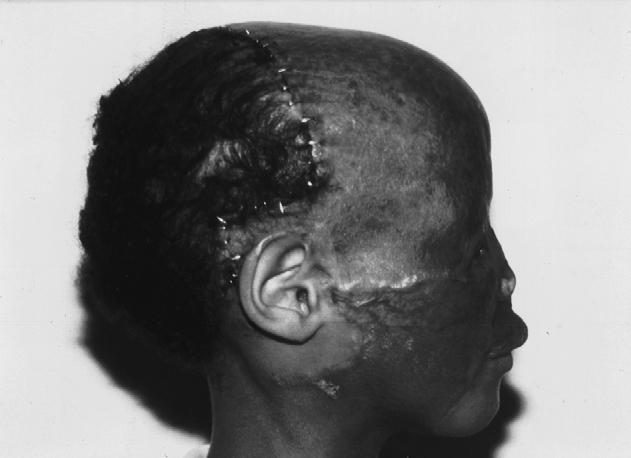 Note that the nose and forehead (and most of the scalp) had had a split skin graft applied to the few muscle fibres above the periosteum.