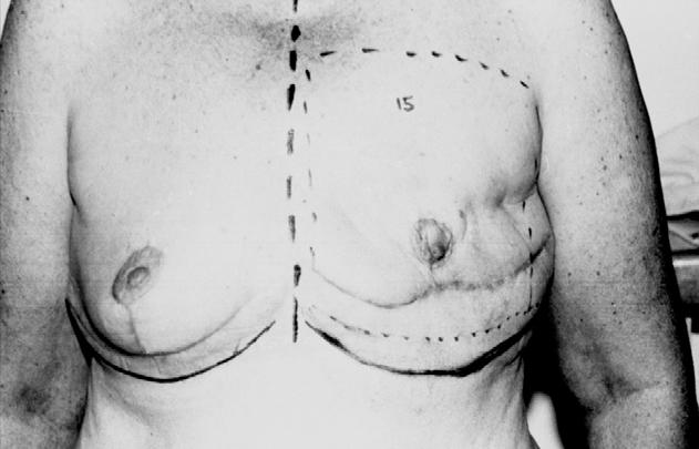 340 D.A. Hudson Figure 8 Patient 6 weeks after subcutaneous cervicofacial rotation flap combined with a subcutaneous tissue expanded flap.