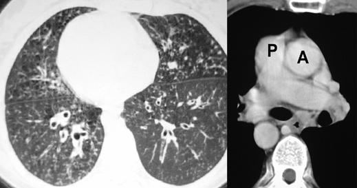 Dextrocardia in Adults Fig. 2 CT scan in 22-year-old man with Kartagener s syndrome. Image of lungs (left image) shows dextrocardia and bronchiectasis.